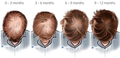 Finasteride Results Timeline: What to Expect .
